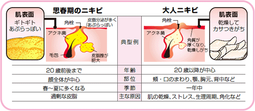 ロート製薬 アクネス25 大人ニキビの治療薬が登場